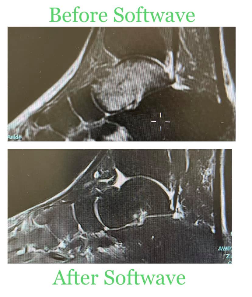 ATL Pain Institute: Leading the Way in Stress Fracture Recovery with SoftWave TRT