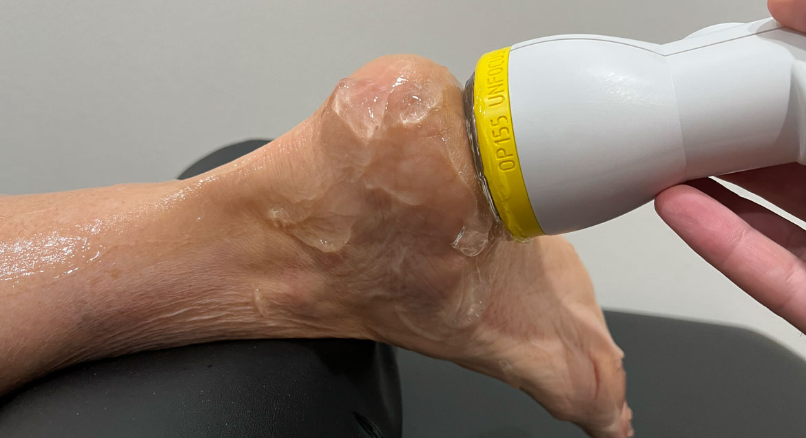 Plantar Fasciitis: Turning the Tide in Atlanta, GA with SoftWave Tissue Regeneration Therapy at ATL Pain Institute